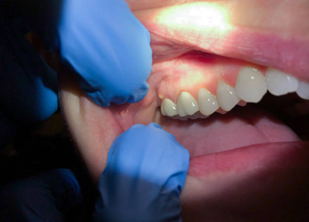 Best Broken Tooth Emergency  in Wye, MT